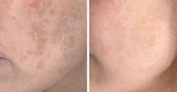 'Zombie cells' are triggering dark spots on face but there is a way to stop them