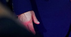 Trump's hand sparks concern at UFC White House event: 'He's rotting from the inside out'
