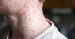 UK holidaymakers alerted after measles outbreak in Spanish tourist hotspot