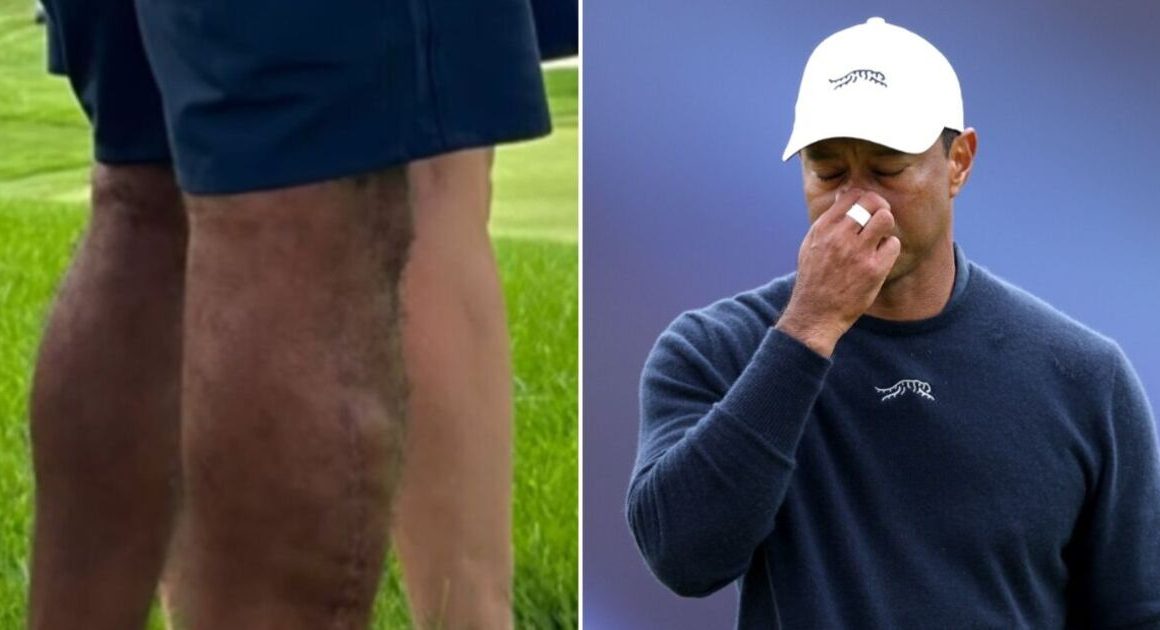 New photo of Tiger Woods’ uncovered leg shows full extent of brutal surgery | Golf | Sport